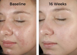 Chemical Peels Before and After