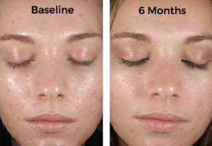 Chemical Peels Before and After