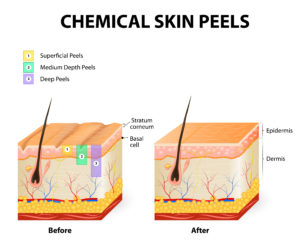 Chemcial Peels Model