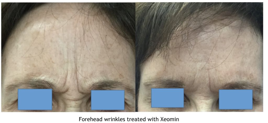 Neuromodulators Before and After