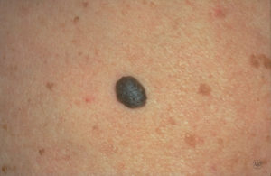 Seborrheic Keratoses