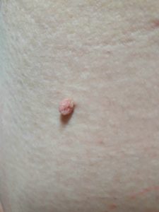 Skin Tag Removal