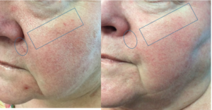 Laser Treatments Before and After