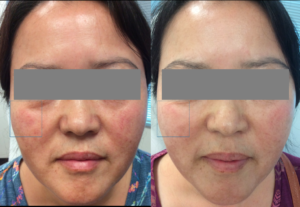 Laser Treatments Before and After