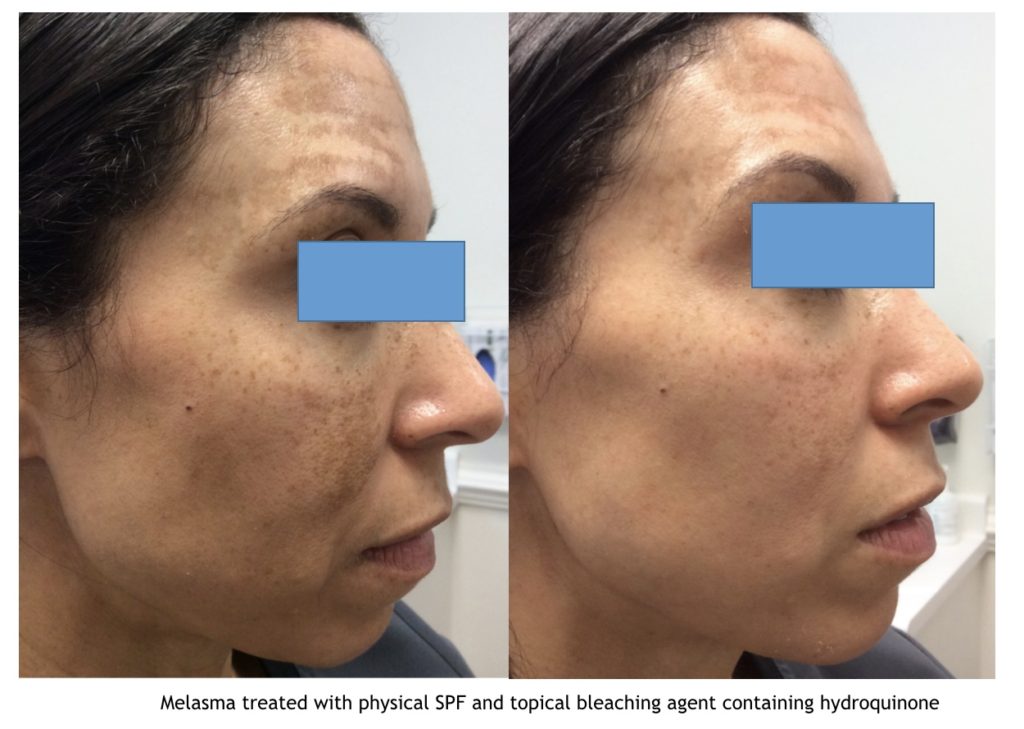 Melasma