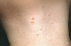 Molluscum Contagiosum