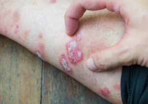 Psoriasis